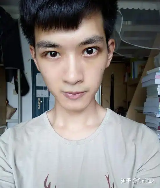  男生做双眼皮手术是什么体验