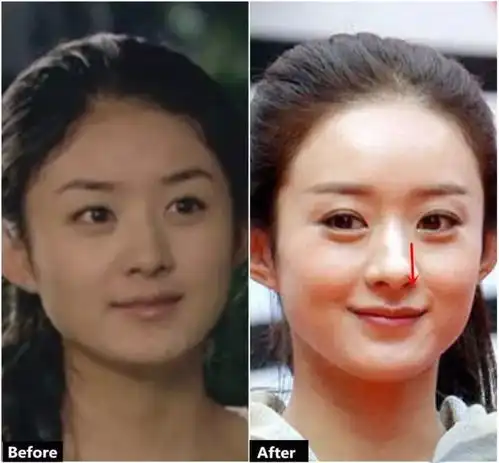  荧屏女王赵丽颖的整容史,简直是一本行走的教科书