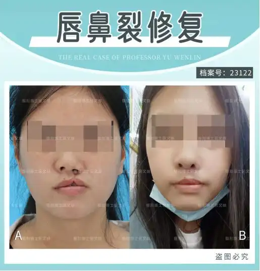 兔唇嘴巴缺了一块,说话漏风这样修复效果很理想